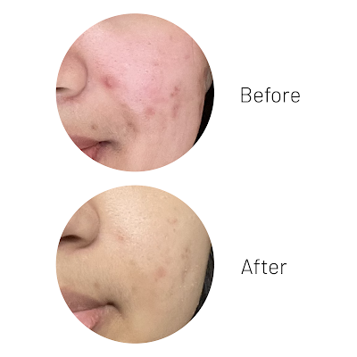 acne center cara mengatasi jerawat dengan acne peeling